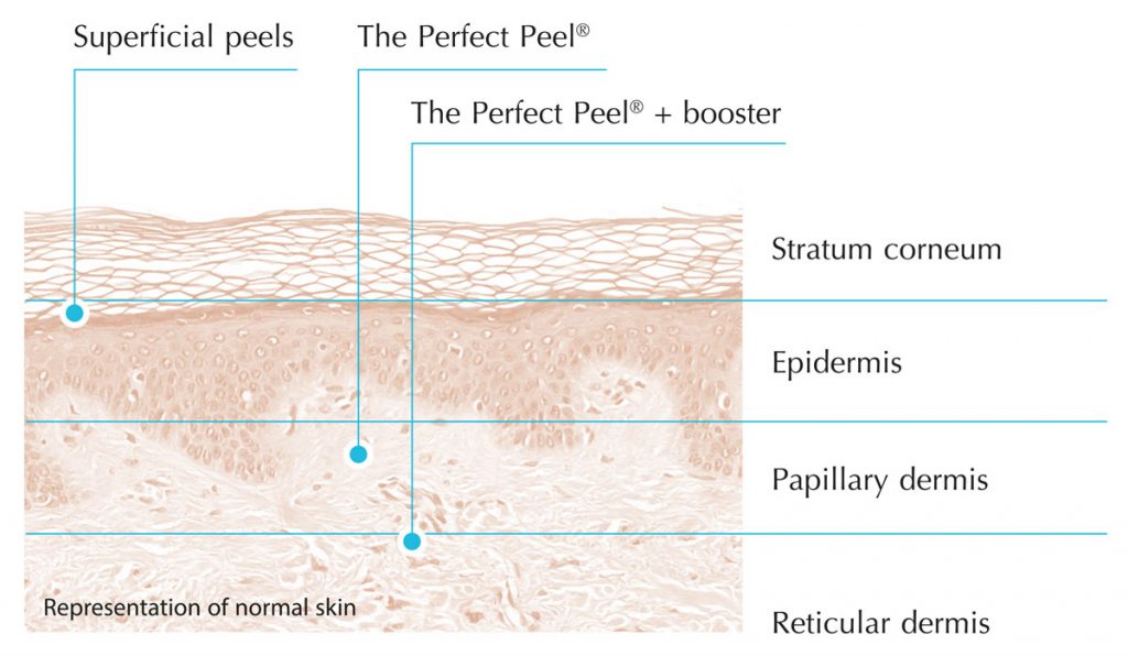 chemical peels depth of action