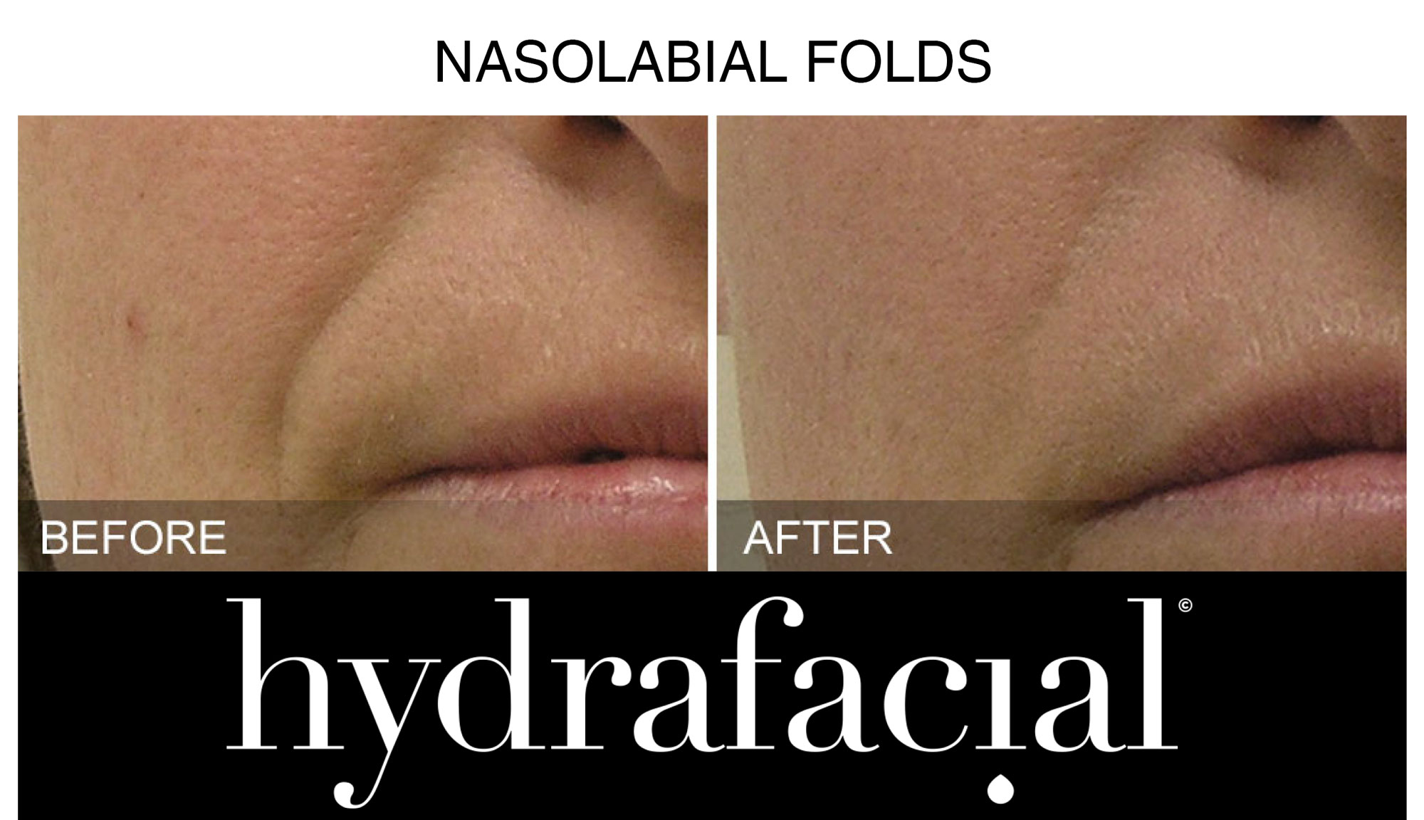 Nasolabial-Folds