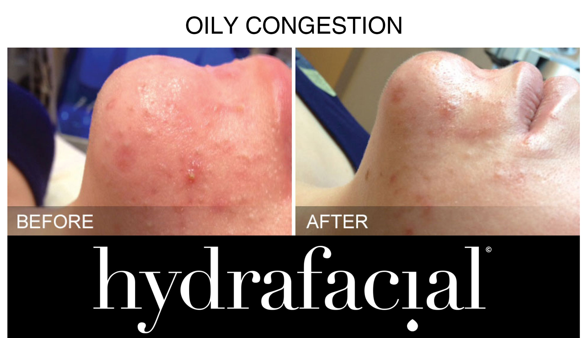 Oily-Congestion