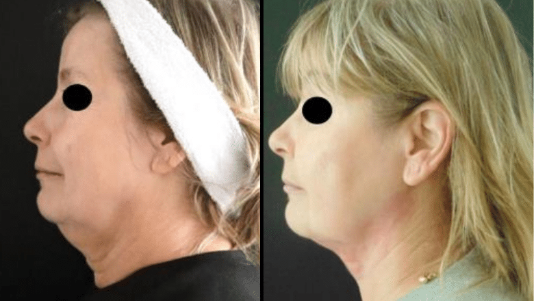 FaceTite-Before-After