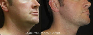 Define Jaw and Remove Unwanted Fat with FaceTite