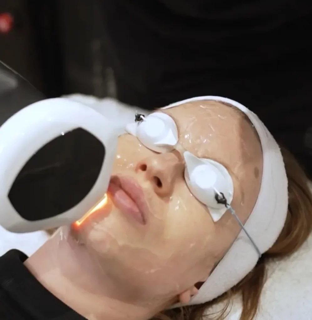 PhotoFacial for Brides