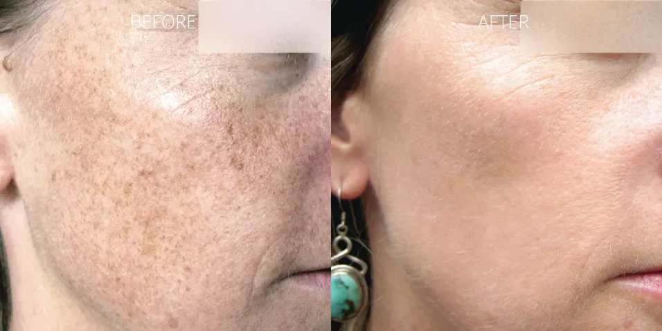 BBL Hero face pigmentation treatment results before and after at Axis Clinic London.