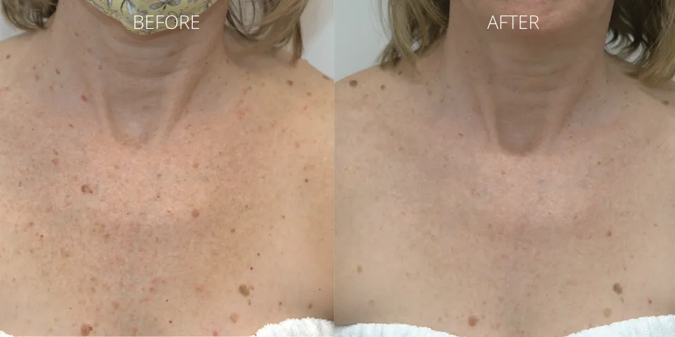 BBL Hero chest pigmentation treatment before and after at Axis Clinic London showing clearer, even-toned skin.