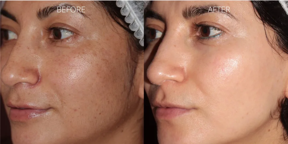 BBL Hero skin rejuvenation before and after results at Axis Clinic London for glowing, youthful skin.