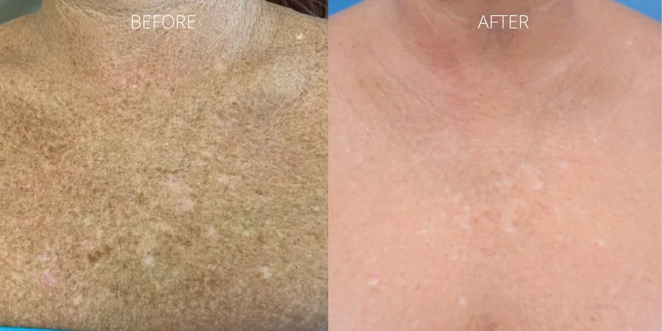 BBL Hero sun damage treatment on the chest before and after results at Axis Clinic London