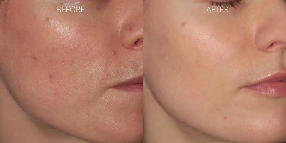 ClearSilk before and after results for acne at Axis Clinic London