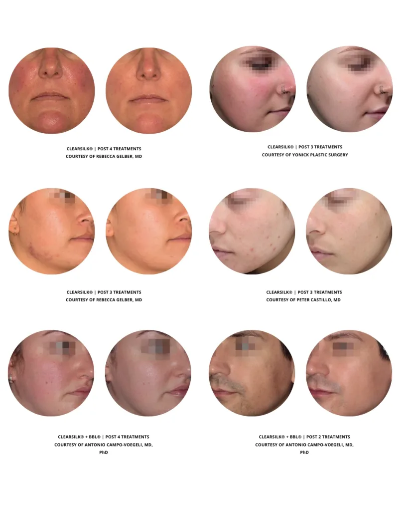 Before and after photos of ClearSilk™ laser treatments showing visible improvements in redness, acne, and overall skin clarity after multiple sessions at Axis Clinic.