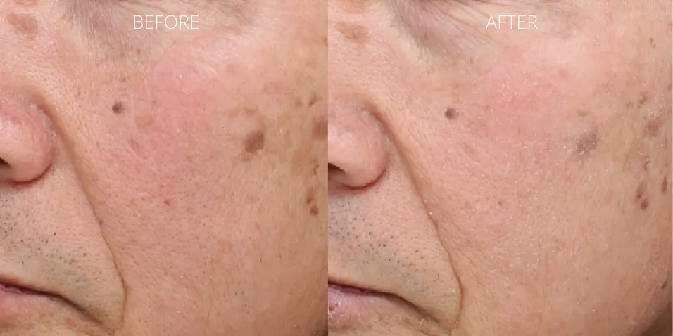 ClearSilk before and after results for pigmentation at Axis Clinic London