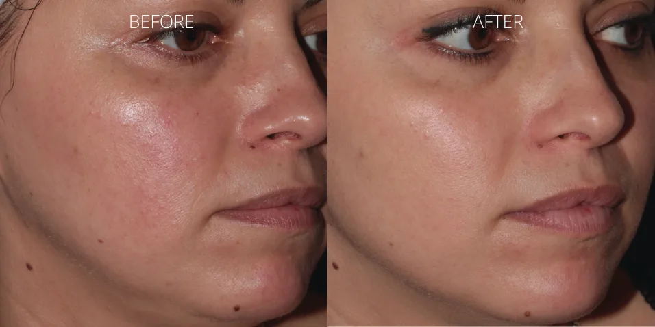 ClearSilk before and after results for redness and skin rejuvenation at Axis Clinic