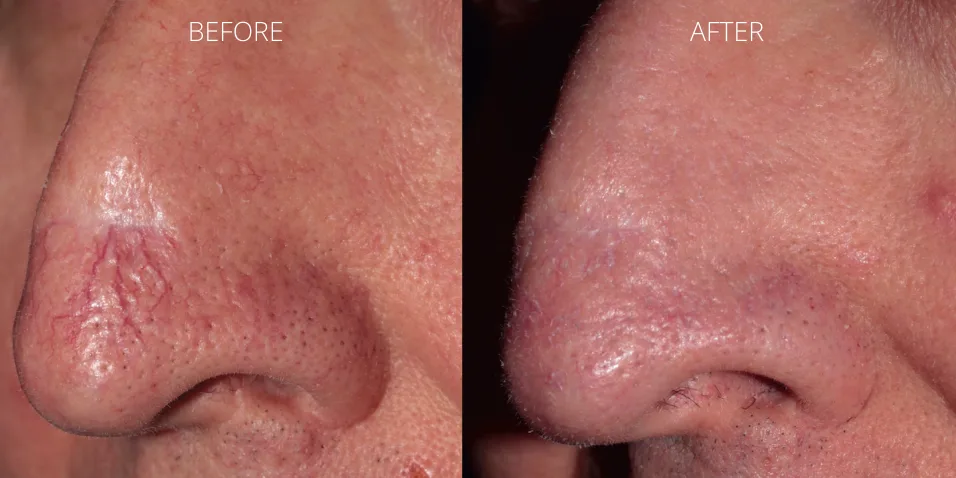 Before and after ClearV™ laser treatment showing reduced broken capillaries on the nose at Axis Clinic London