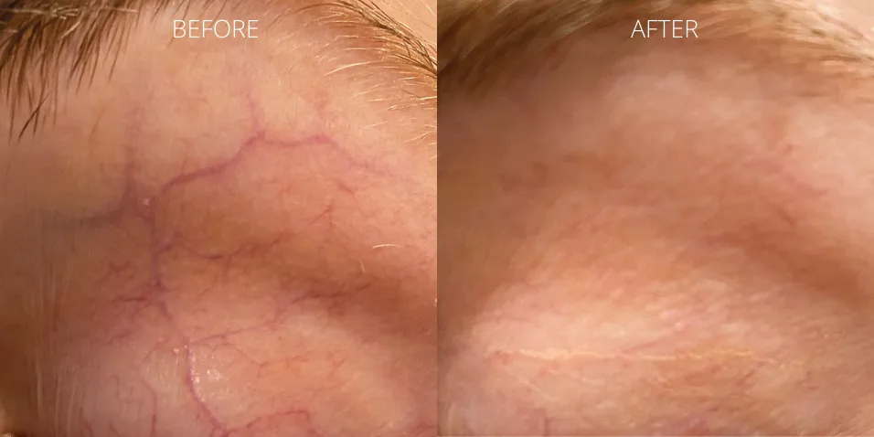 Before and after ClearV™ laser treatment showing reduced forehead veins at Axis Clinic London