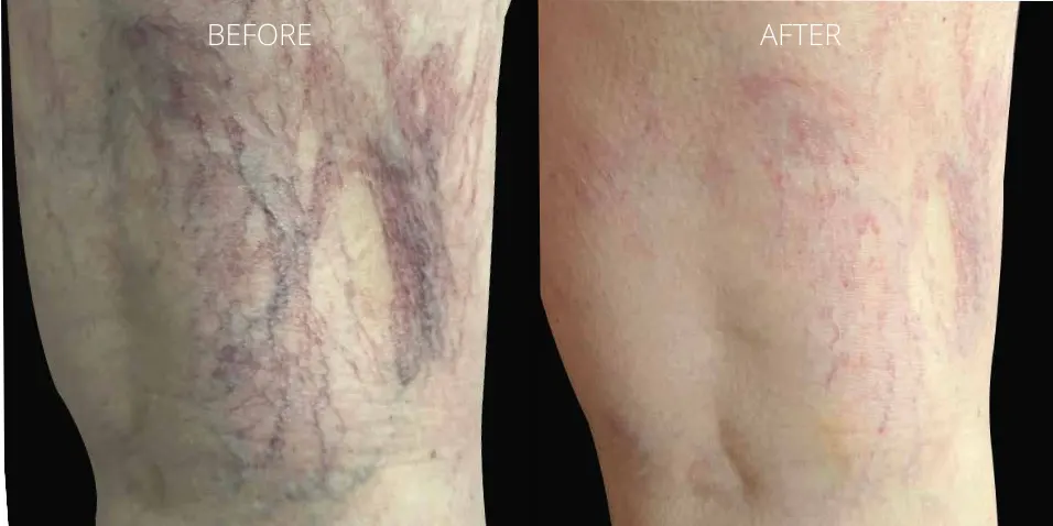 Before and after ClearV™ laser treatment showing reduced leg veins at Axis Clinic London