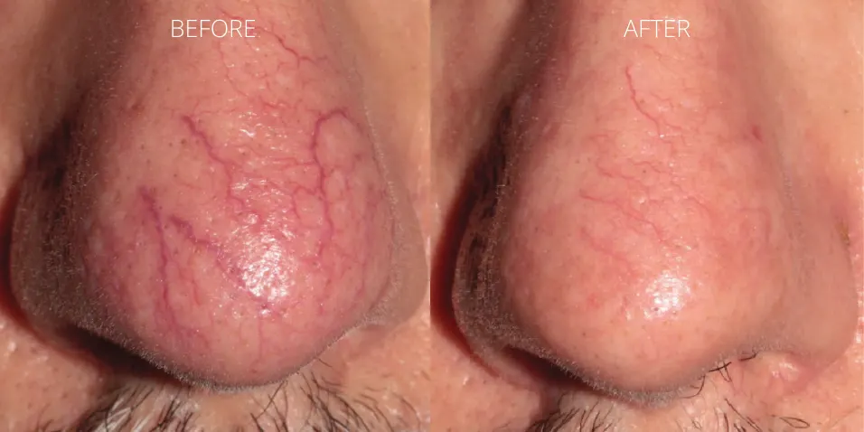 Before and after ClearV™ laser treatment showing visible improvement in nose veins at Axis Clinic London