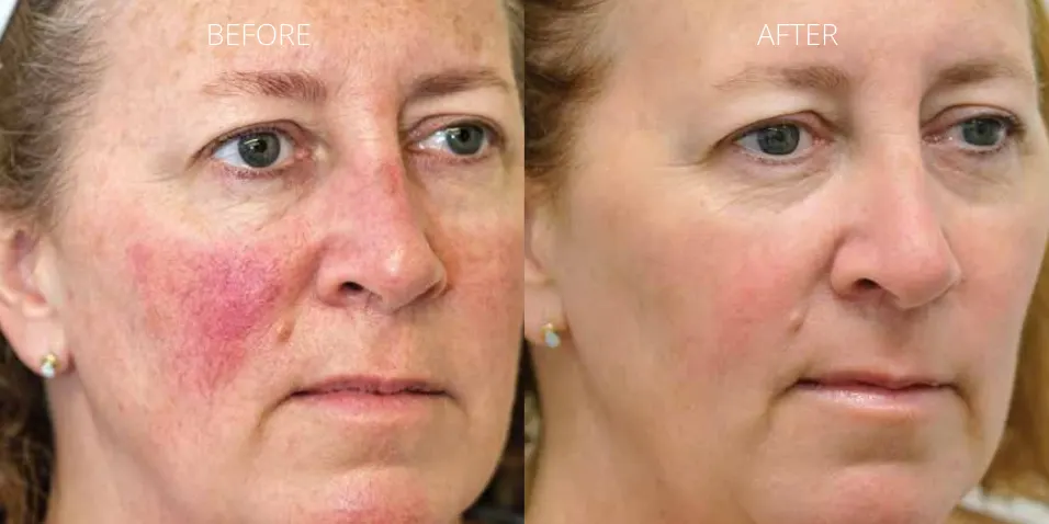 Before and after ClearV™ laser treatment showing reduced redness and rosacea on the cheeks at Axis Clinic London