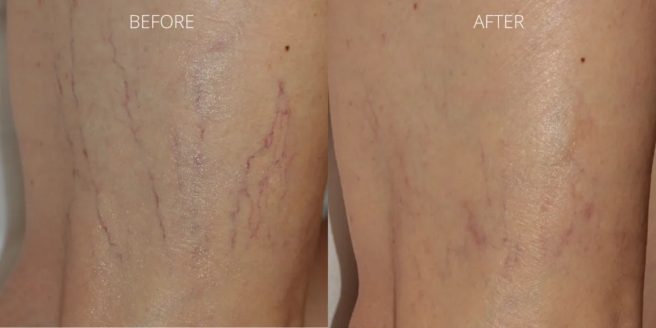 Before and after ClearV™ laser treatment showing reduced spider veins on legs at Axis Clinic London