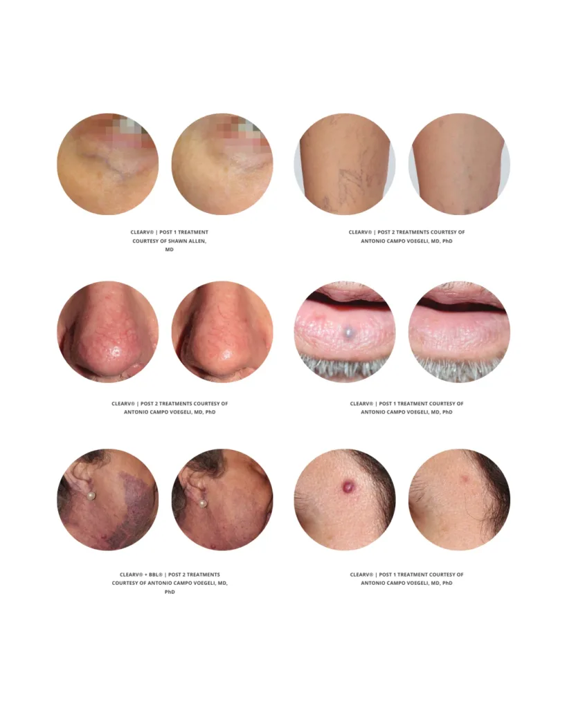 Before and after laser treatments showing visible improvements in facial veins, leg veins, venous lakes, port wine stains, and skin vascular concerns at Axis Clinic London