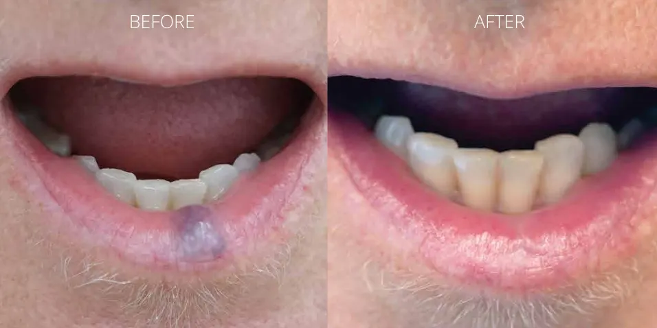 Before and after ClearV™ laser treatment showing successful venous lake removal on the lip at Axis Clinic London