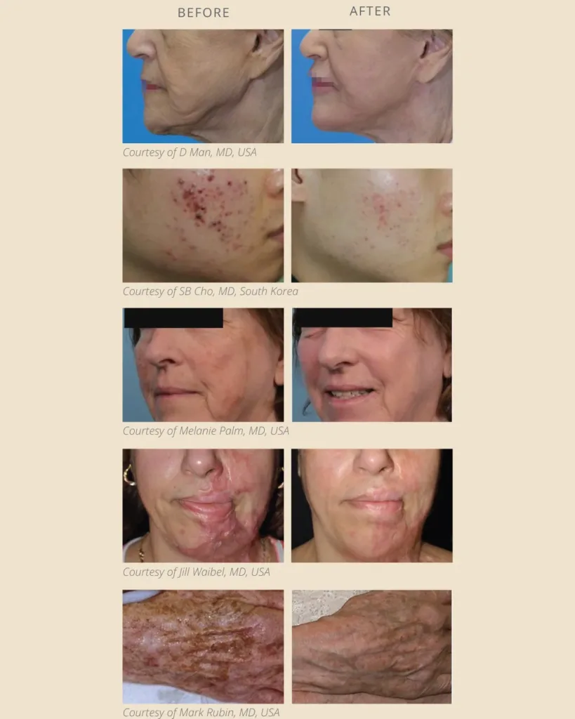 co2-laser-before-after-results-axis-clinic.webp CO2 laser before and after results at Axis Clinic London showing skin improvements for wrinkles, acne scars, pigmentation, scars and ageing hands.