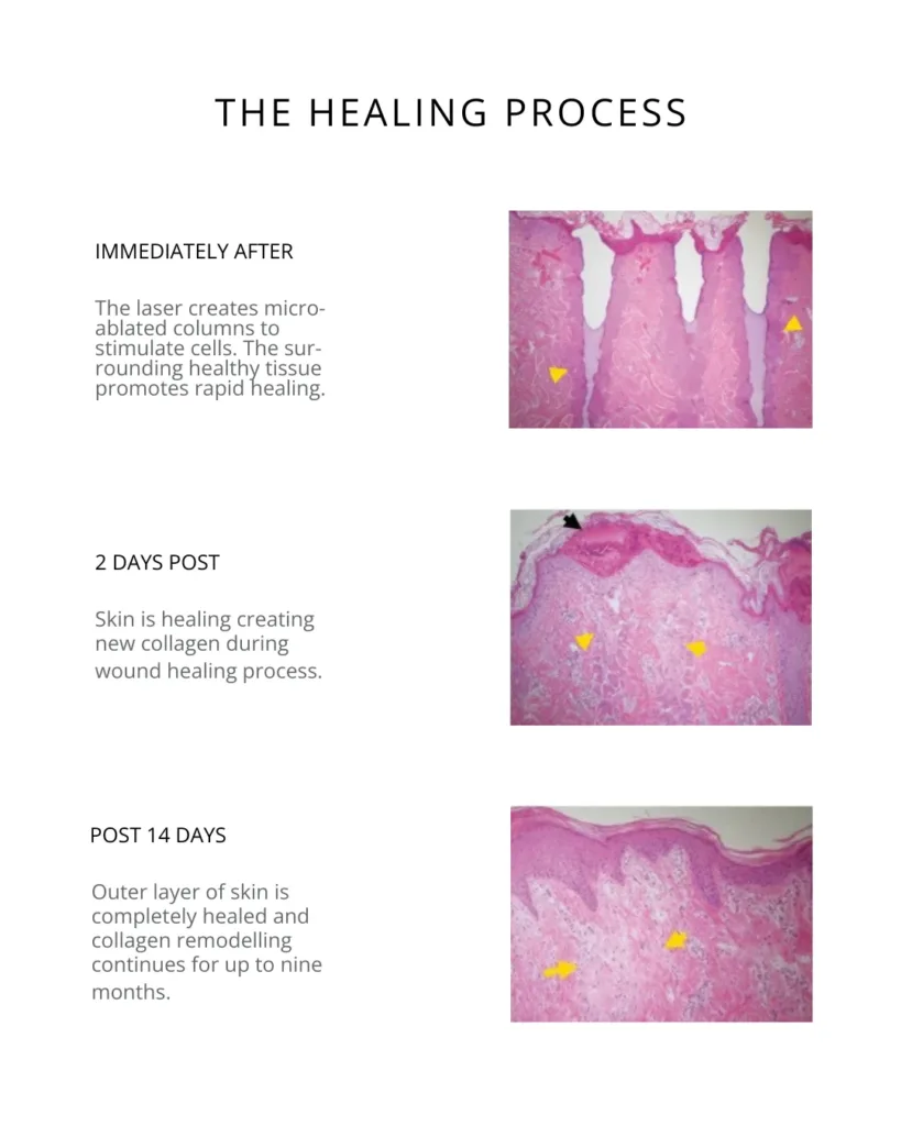 Healing stages after CO₂ laser resurfacing, showing immediate tissue ablation, collagen formation at 2 days, and full skin recovery after 14 days.