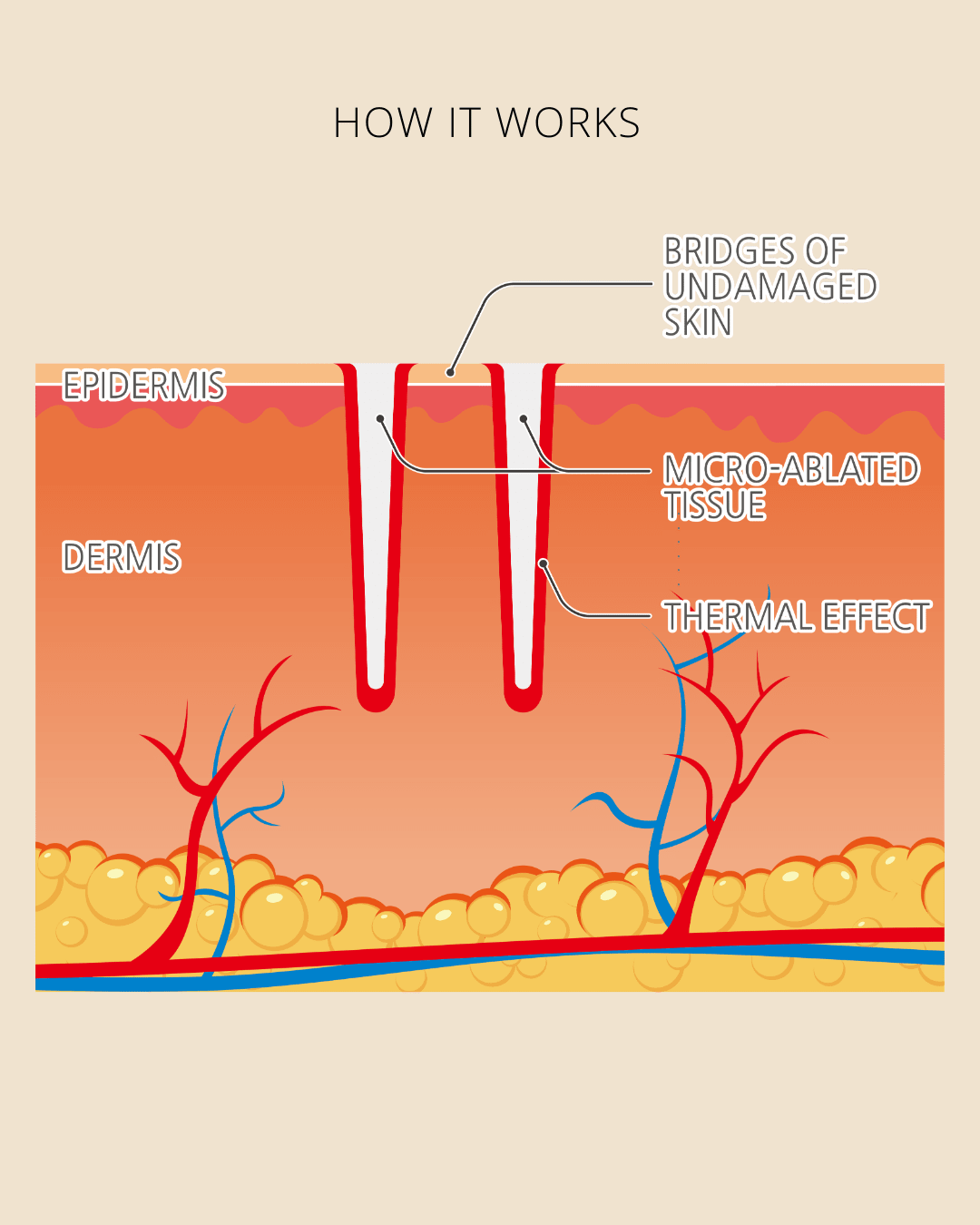Diagram showing how fractional CO₂ laser creates micro-ablated tissue with bridges of healthy skin to promote faster healing.