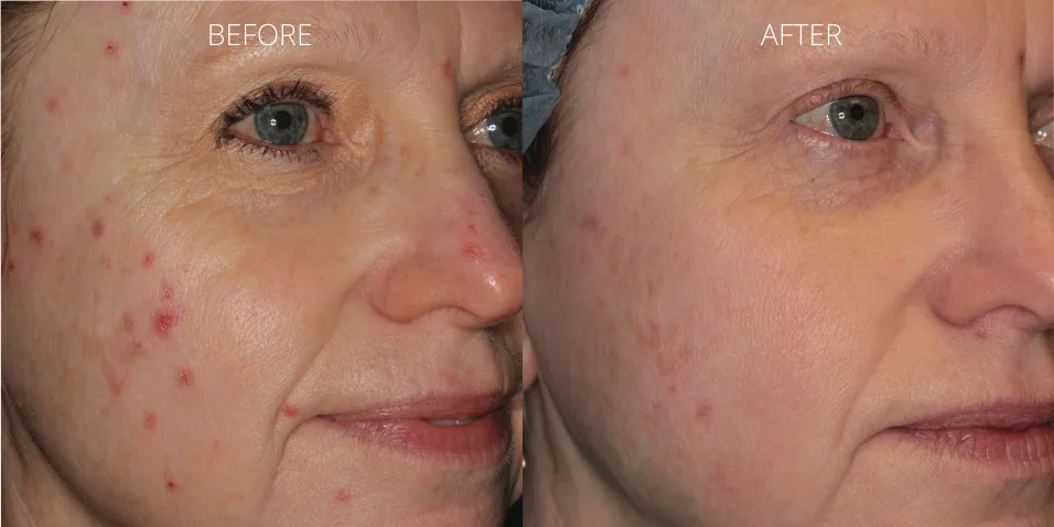 Forever Clear BBL acne treatment results at Axis Clinic London showing reduction in active acne and redness.