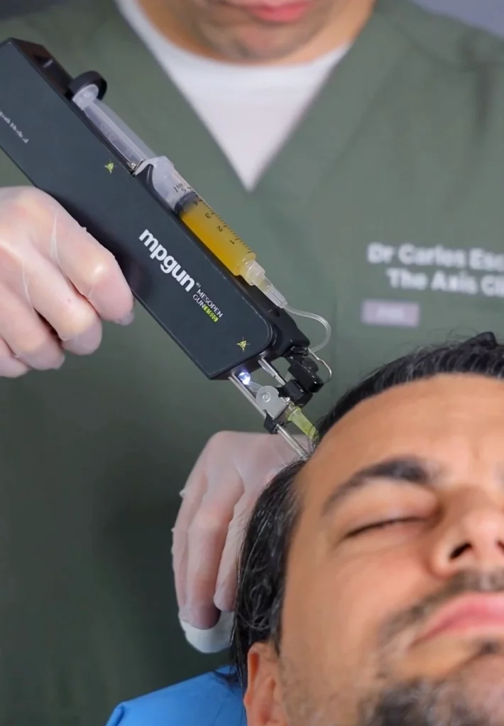 PRP hair restoration treatment performed at The Axis Clinic London to stimulate hair growth and strengthen follicles.