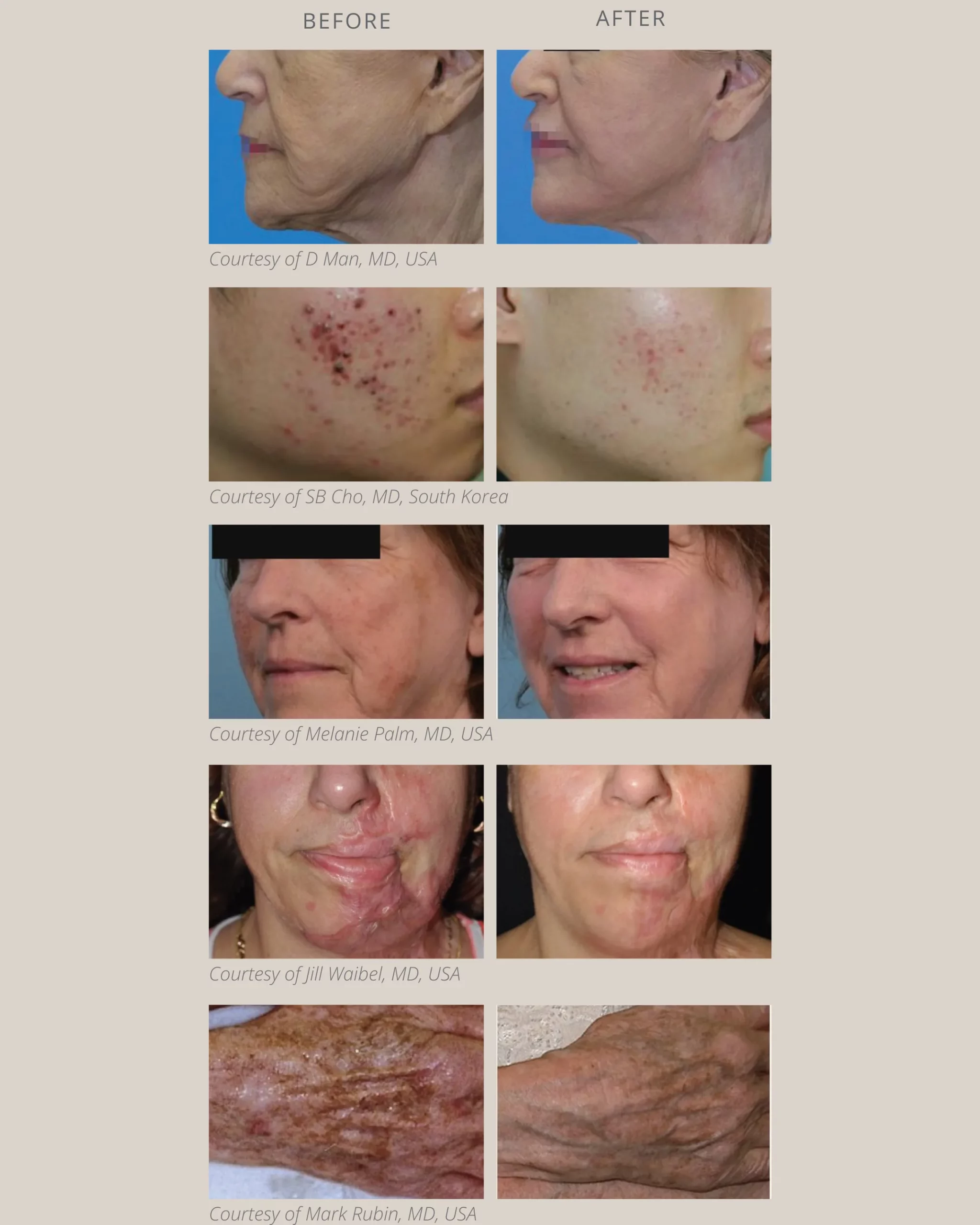 co2-laser-before-after-results-axis-clinic.webp CO2 laser before and after results at Axis Clinic London showing skin improvements for wrinkles, acne scars, pigmentation, scars and ageing hands.