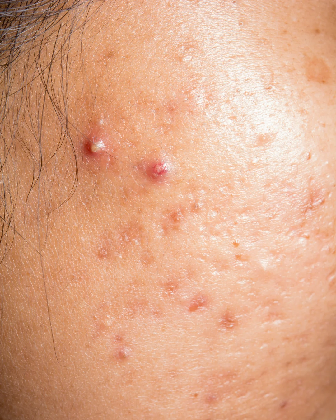 Woman with active acne before treatment at Axis Clinic London