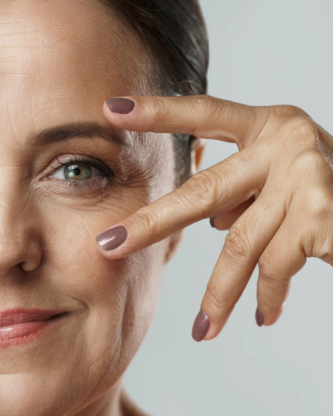 Woman with fine lines, wrinkles, and under-eye hollows before treatment at Axis Clinic London