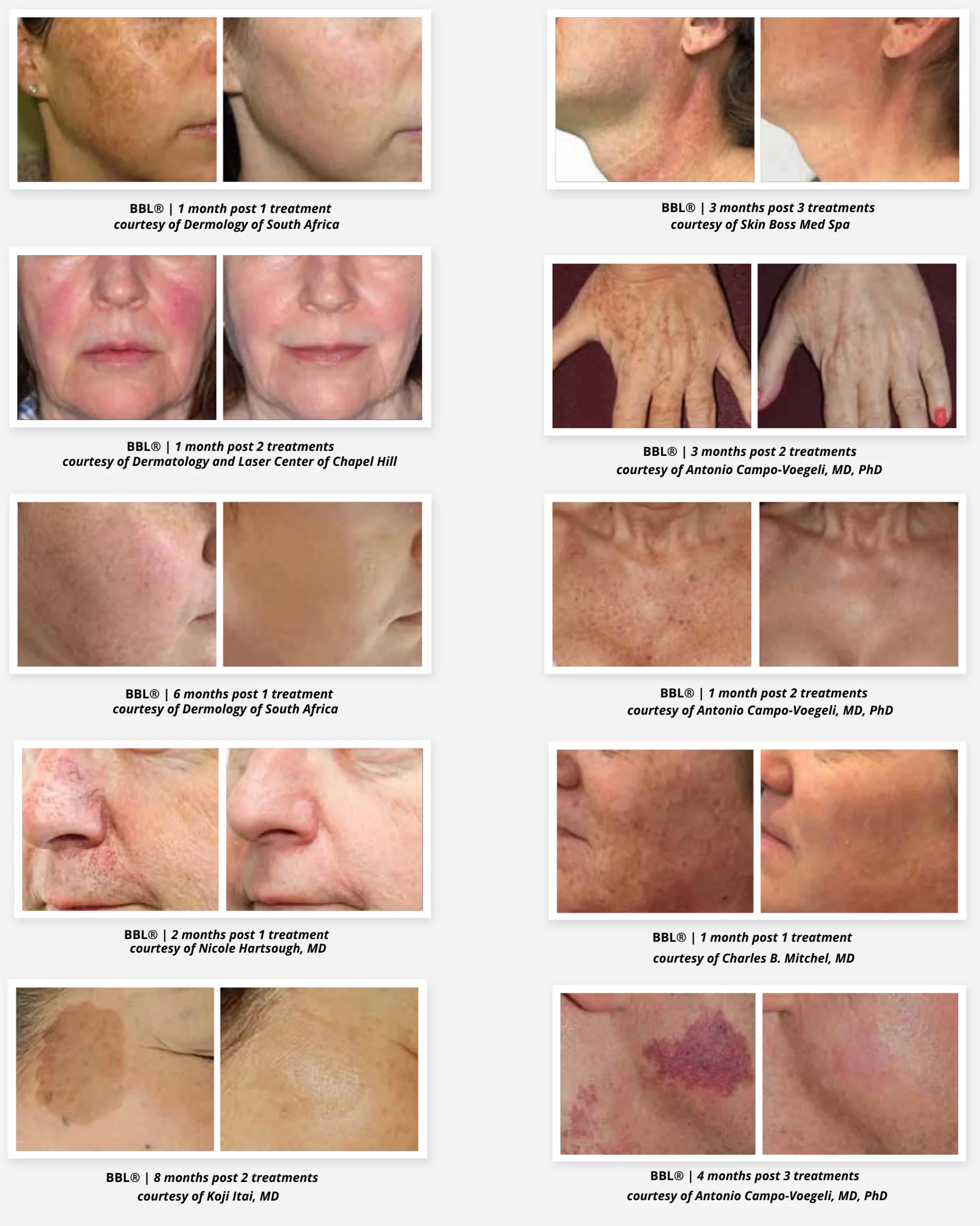 before and after results at Axis Clinic London showing improvements in pigmentation, redness, sun damage, skin texture, and overall rejuvenation.