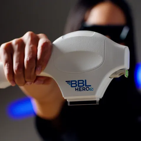 Close-up of BBL Hero Treatment in London