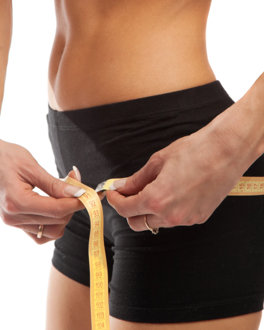 Woman with hip dips and buttock volume loss before treatment at Axis Clinic London