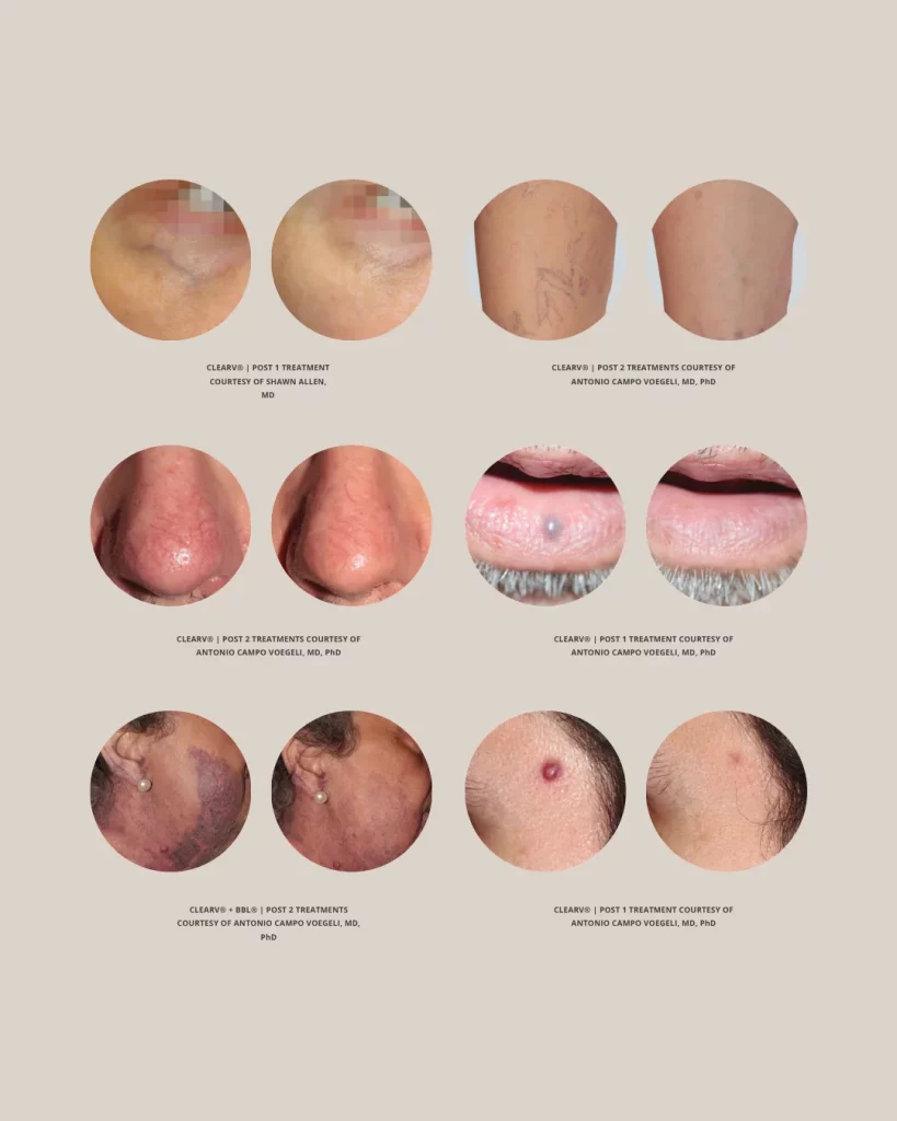 Before and after laser treatments showing visible improvements in facial veins, leg veins, venous lakes, port wine stains, and skin vascular concerns at Axis Clinic London