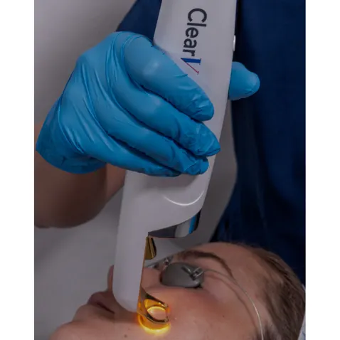 laser treatment being performed at Axis Clinic London to target visible facial veins