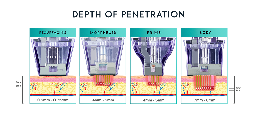 Diagram showing depth of penetration of Morpheus8 microneedling and radiofrequency treatment at The Axis Clinic in North London