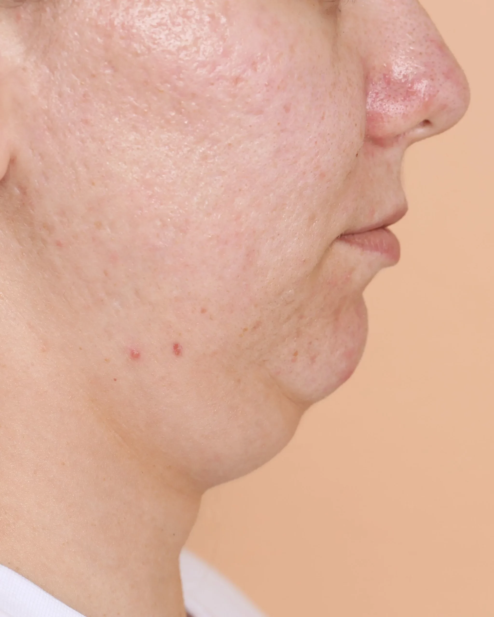 Person with a double chin and sagging neck before skin tightening treatment at Axis Clinic London