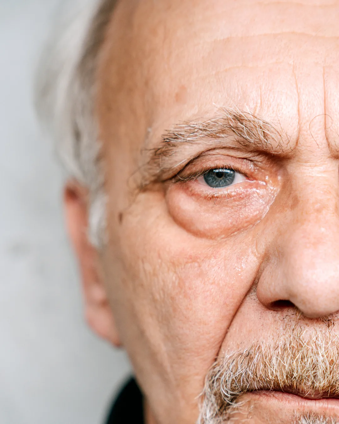 Person with fine lines, wrinkles, and under-eye hollows before treatment at Axis Clinic London