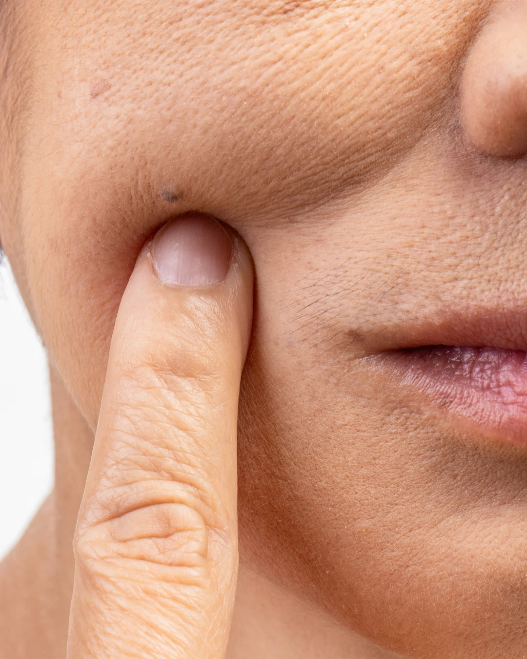 Woman with facial hollowness before treatment at Axis Clinic London