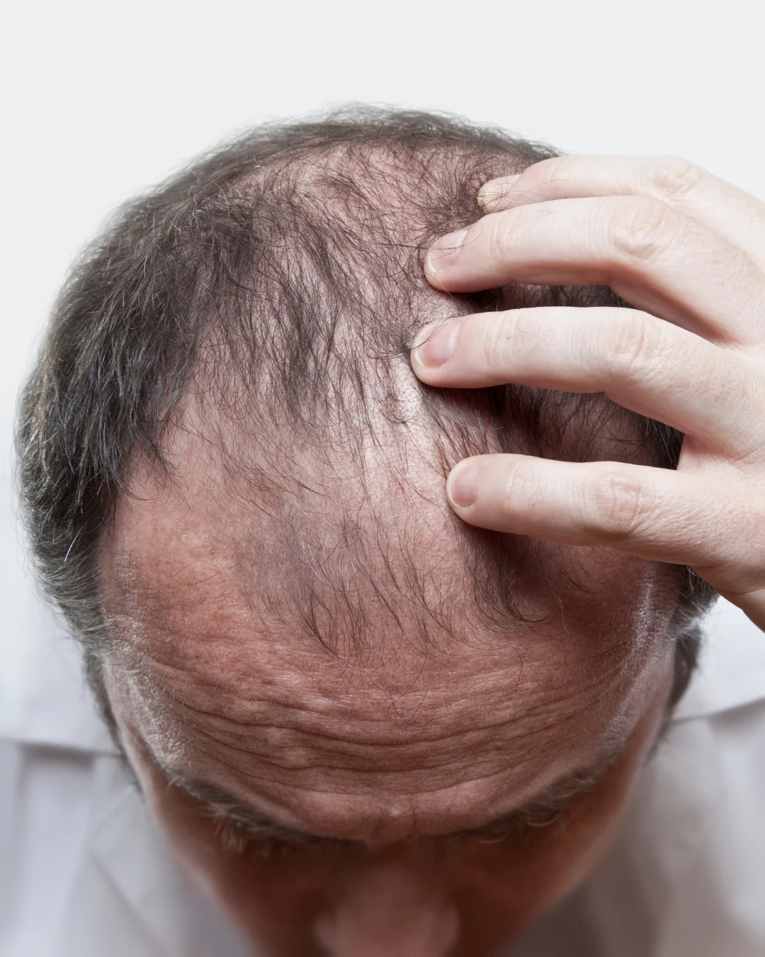 Man showing fuller hair after hair restoration treatment at Axis Clinic London