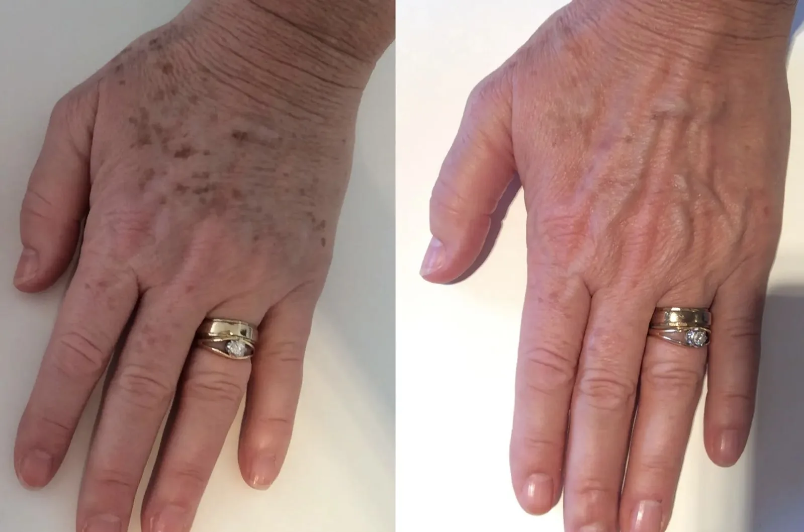Lumecca London – Hand Pigmentation Removal Results | The Axis Clinic