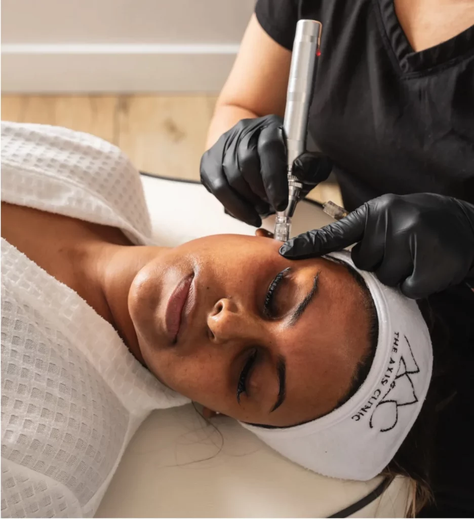 Microneedling with PRP treatment at The Axis Clinic in North London to rejuvenate and revitalise the skin.