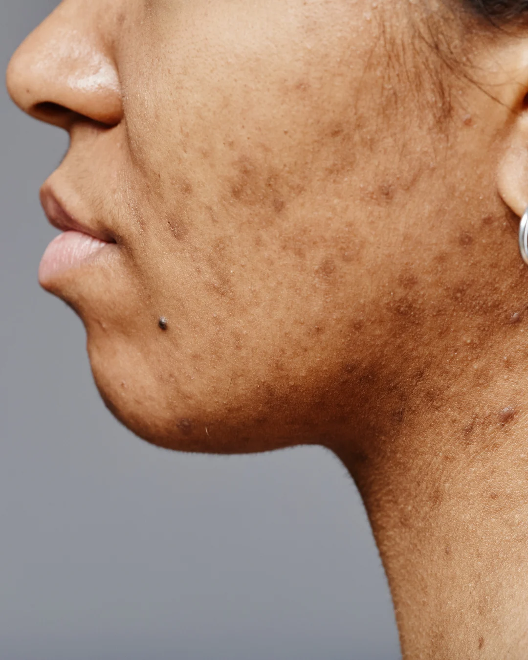 Woman with facial pigmentation treated at Axis Clinic London