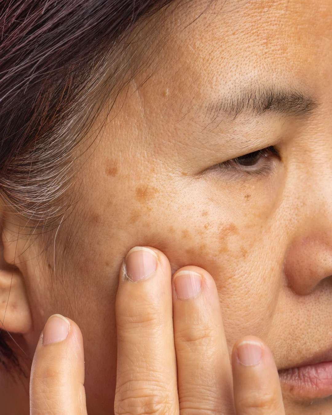 Woman showing pigmentation before and after treatment at Axis Clinic London