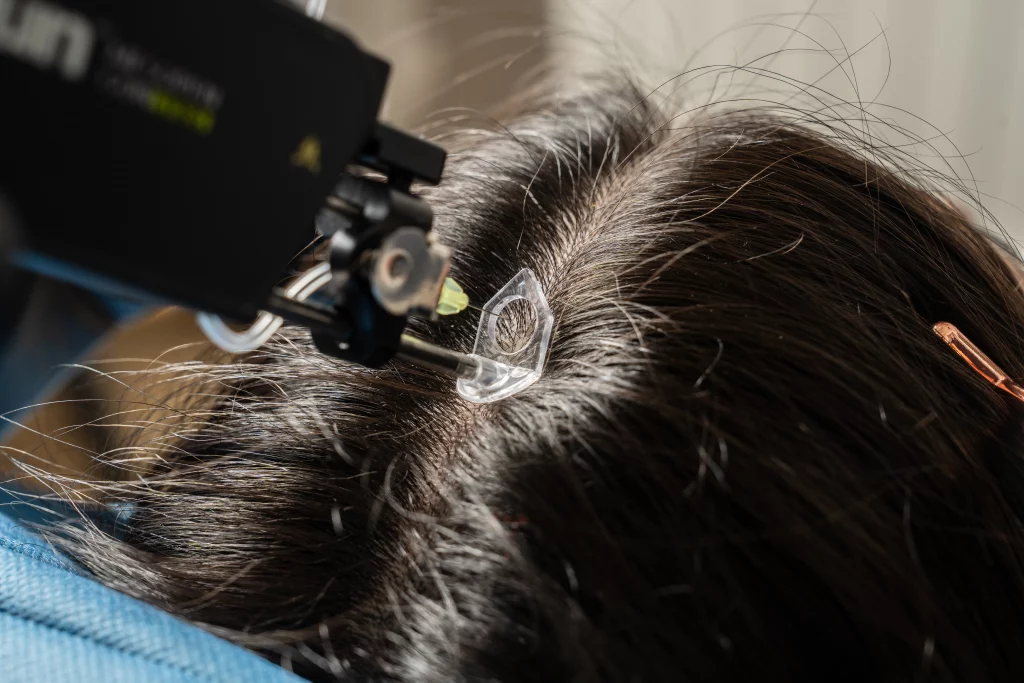 PRP and LaseMD combined treatment at The Axis Clinic in North London to rejuvenate skin and stimulate hair growth