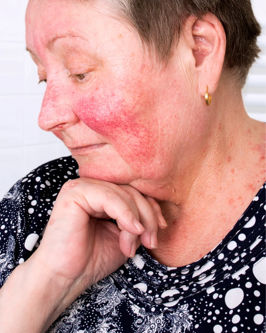 Woman with facial redness and rosacea before treatment at Axis Clinic London