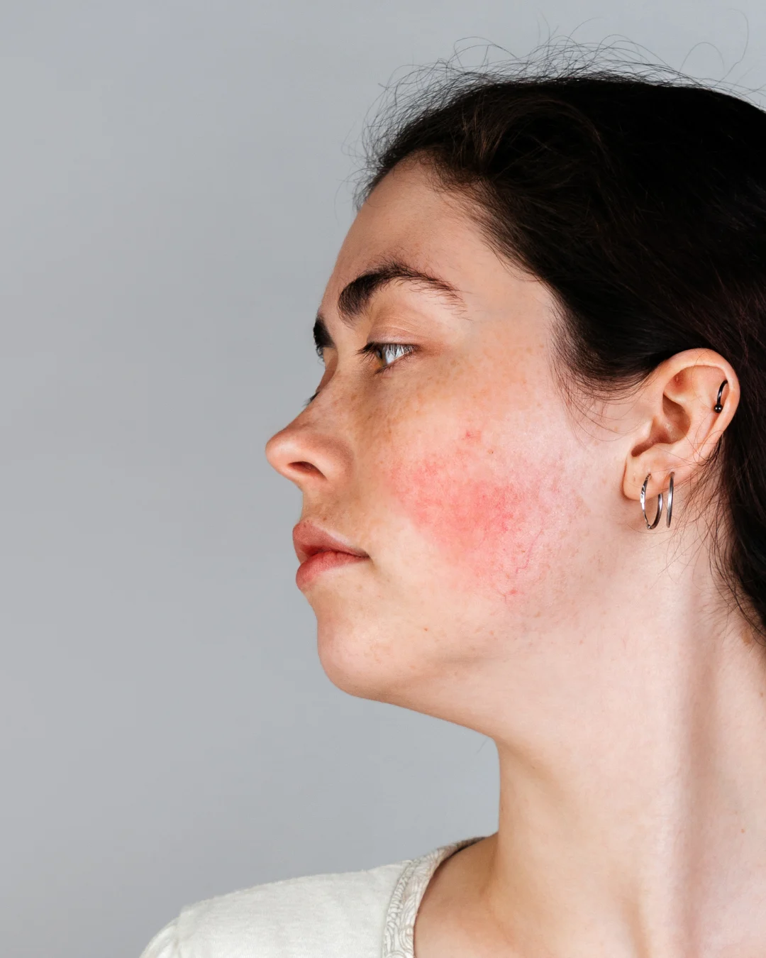 Woman after rosacea and redness treatment at Axis Clinic London