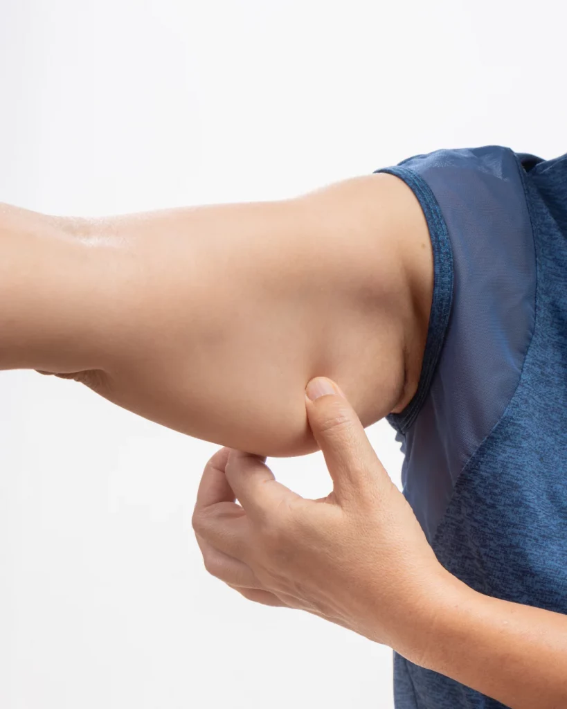 Person with sagging skin on the upper arm before Non-Surgical Arm Lift treatment at Axis Clinic London