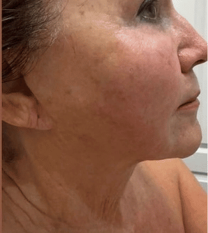 After XERF treatment