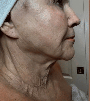 Before XERF treatment